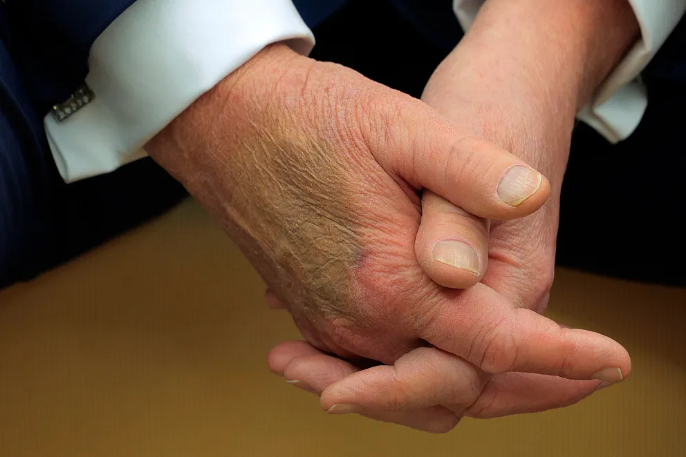 Makeup covers a bruise on the back of Donald Trump's hand as he hosts Emmanuel Macron for meetings at the White House in Washington, DC, on February 24, 2025 | Source: Getty Images